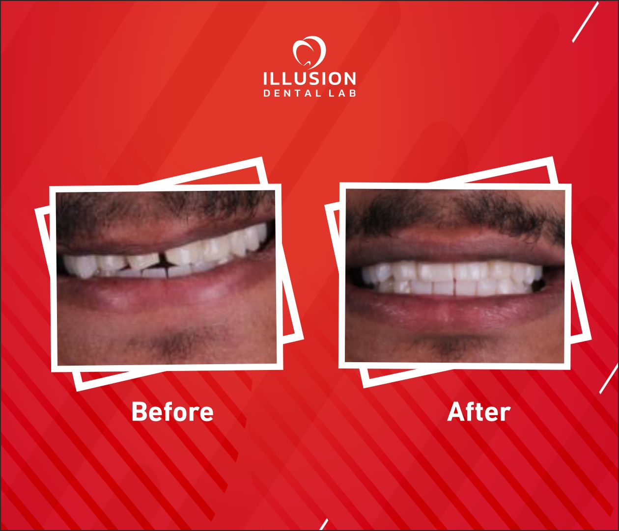 midline diastema closure